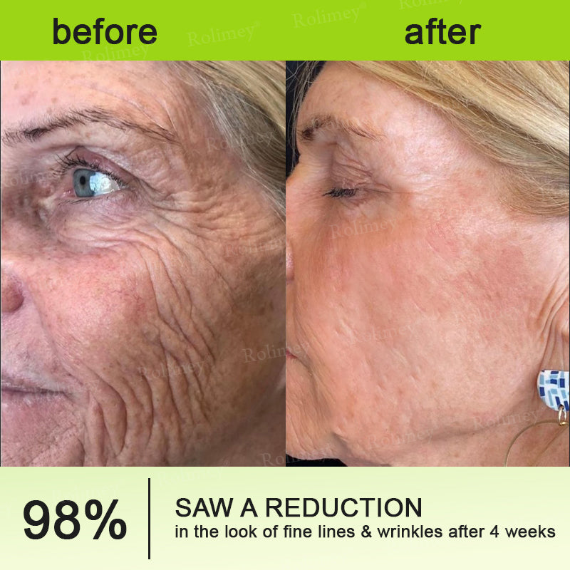 💎Made and shipped from the USA Rolimey® Botox & Vita-A Retinol Shot Wrinkle-Lift Tightening cream - Last Day Promotion 70% OFF